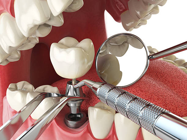 Best Emergency Dental Care for Broken or Chipped Teeth in Langston, OK